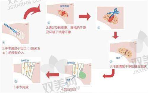 深圳福雅胡俊杰丰臀价格表