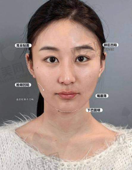 注射后维持时间：你能美多久？