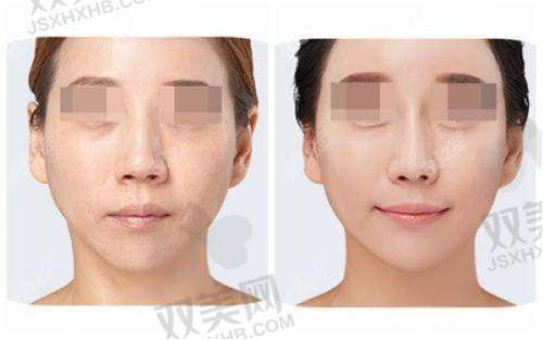 欣德美和乔雅登的术后成效及维持时间
