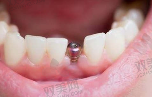 半口纯钛假牙与其他假牙材料的对比