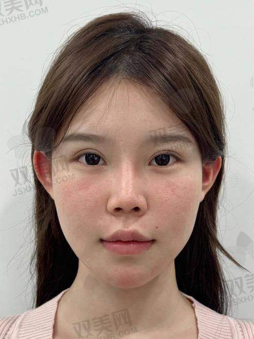 凹陷填充的材料选择