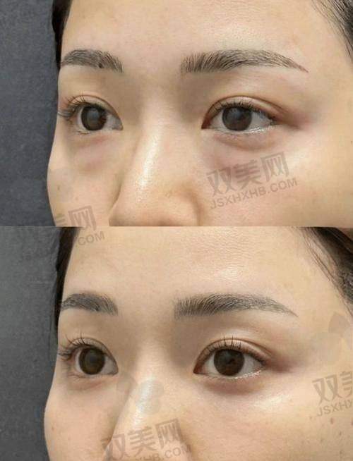 想做祛眼袋的小伙伴需要注意些什么？