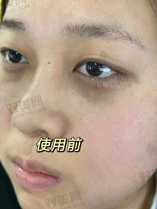 术后注意事项