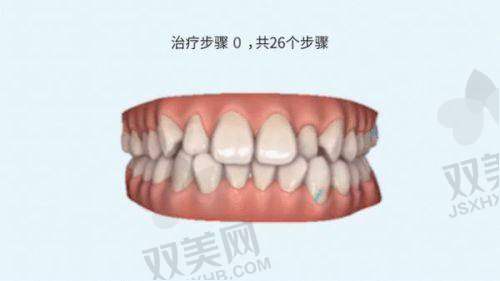 牙齿代偿性正畸和掩饰性正畸的原理