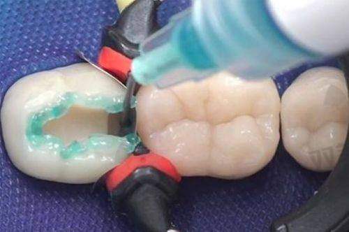 树脂补门牙缝的牢固性怎么样