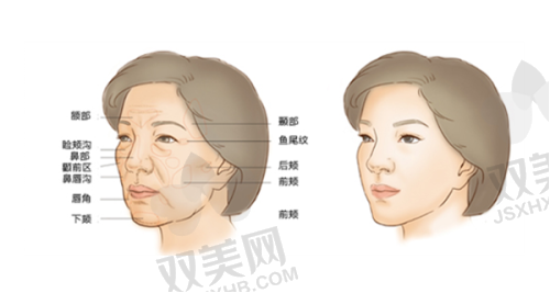 润致娃娃针填充泪沟的成效