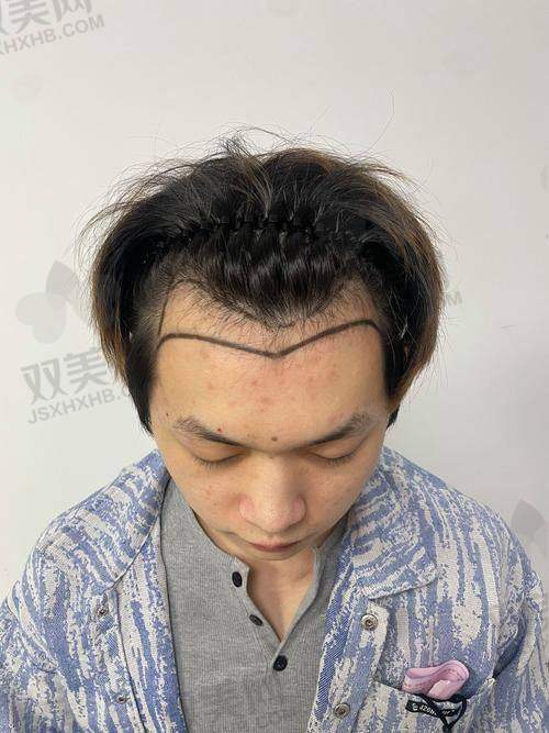 三、长沙哪些医院已经上线了FUE 4.0+微针植发？推荐TOP10清单来了！