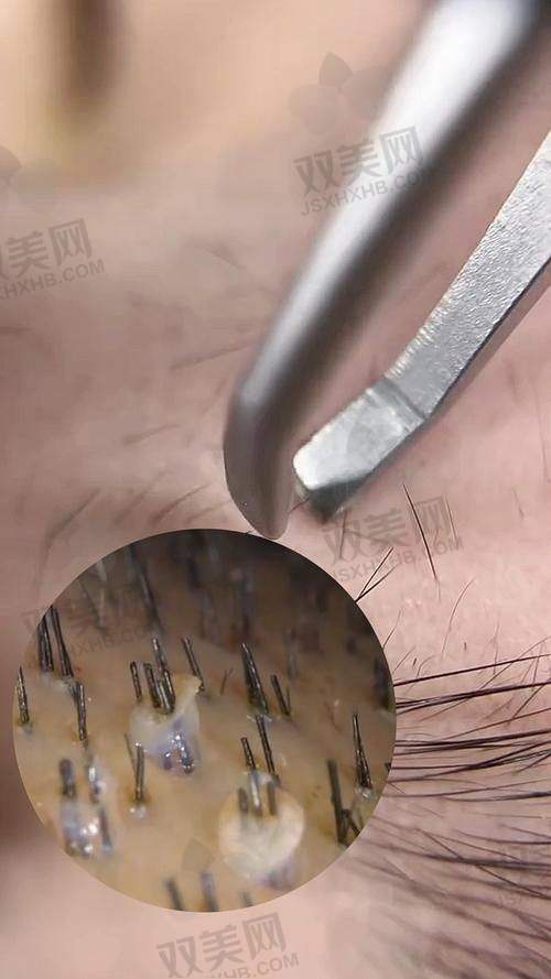 一、FUE是什么？为啥它现在这么火？