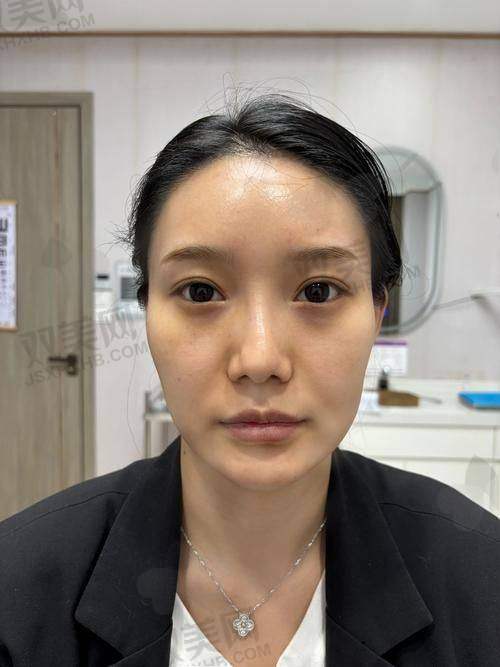二、怡秀玻尿酸多少钱一支？会不会特别贵？