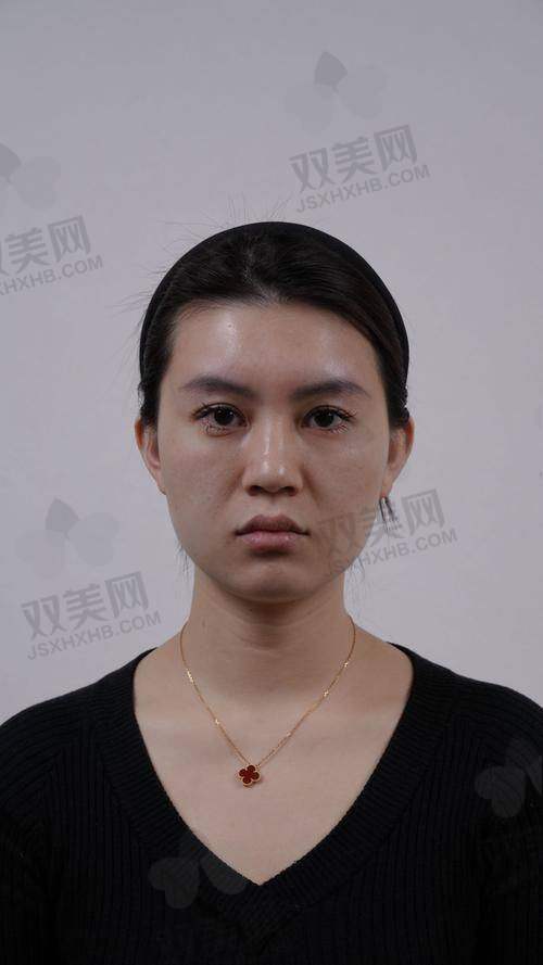 八、业内对怡秀玻尿酸的真实评价如何？