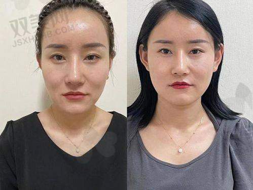 ? 普丽妍童颜针是谁家的？偷偷告诉你这个国产品牌已拿“国内认证”了！