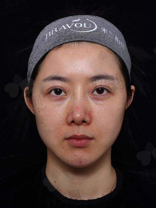 一、怡秀玻尿酸是啥来头？到底是行业佼佼者还是杂牌？