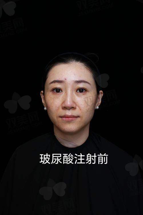 ? 普丽妍童颜针长啥样？目前国内只有这款型号！