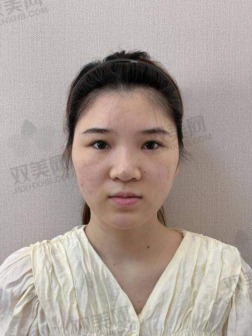 ? 普丽妍童颜针适合注射哪些部位？全脸填充地图奉上！