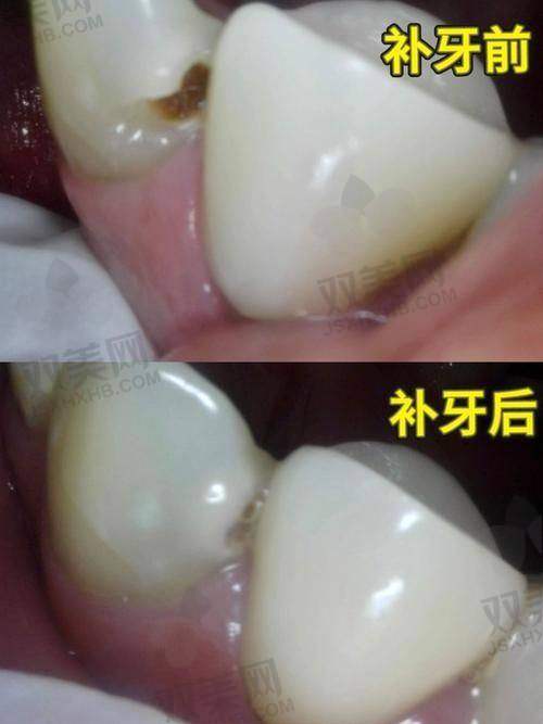 树脂补门牙缝的成效究竟如何