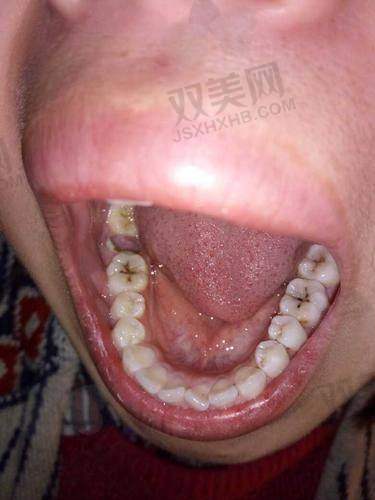 树脂补门牙缝后需要注意什么