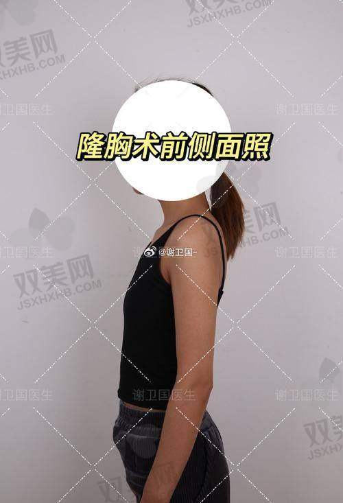 实例揭秘：“开内眼角居然能有这种成效？”