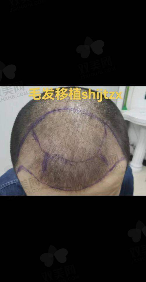 毛囊检测，了解自身情况