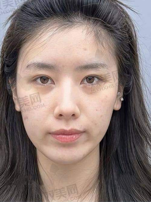 价格参考：海伊龄水光值不值得打？