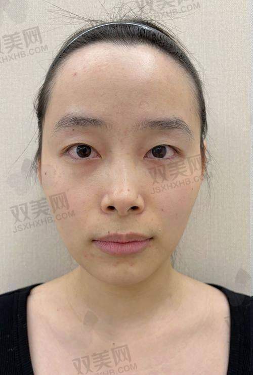 玻尿酸的成效能维持多久？