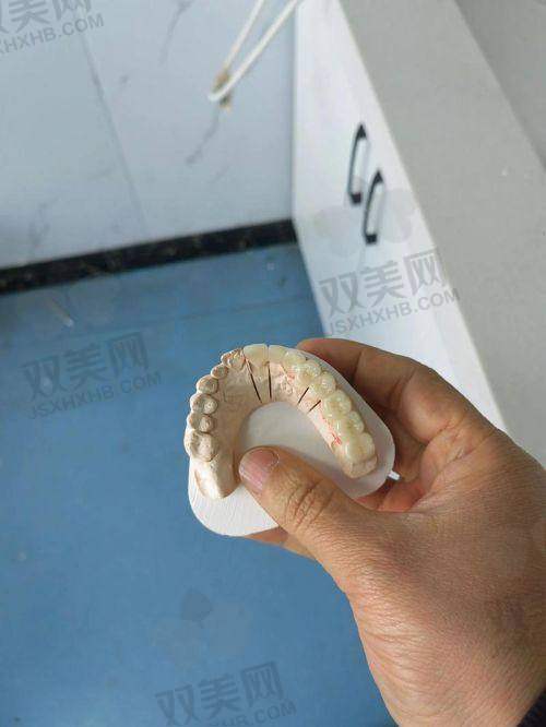拉瓦全瓷牙的优点解析