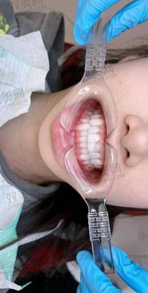 深覆合的定义与危害