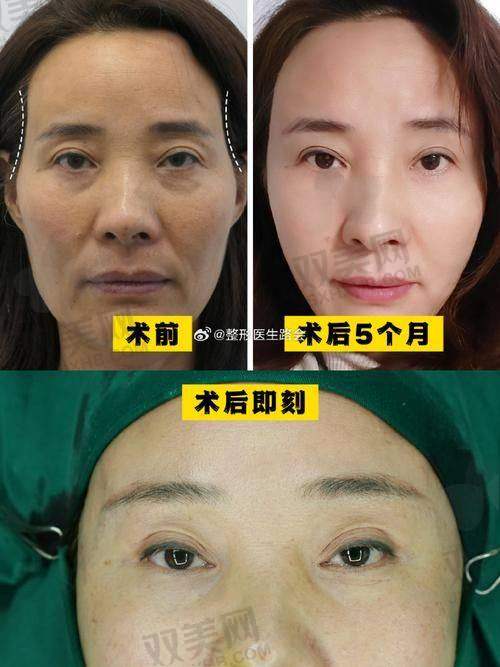 脸部凹陷填充后的修复方法