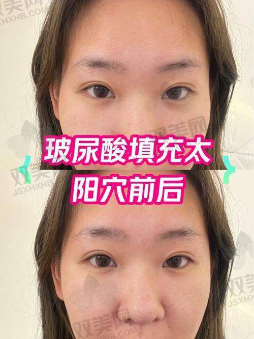 如何选择合适的填充材料和医院