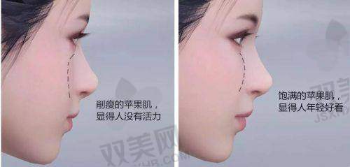 脸部凹陷填充费用受哪些因素影响