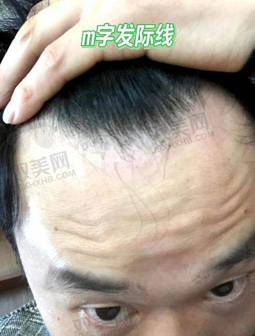脱发困扰，下定决心植发