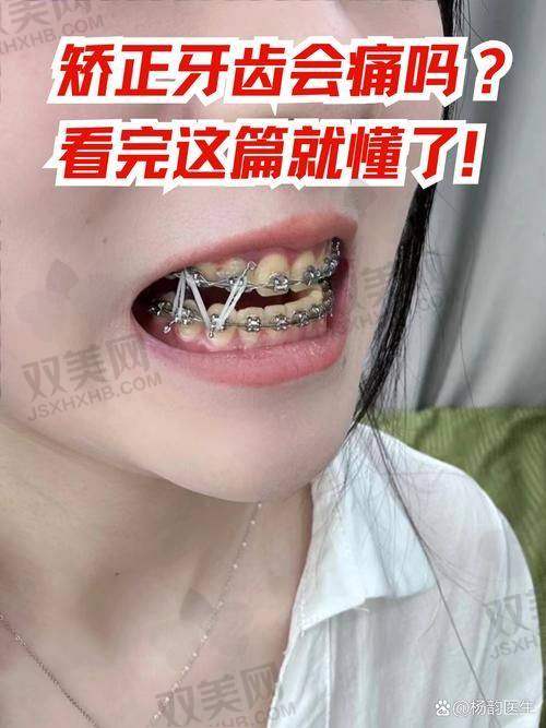 儿童替牙期（7~11岁）：矫正机会的前奏阶段