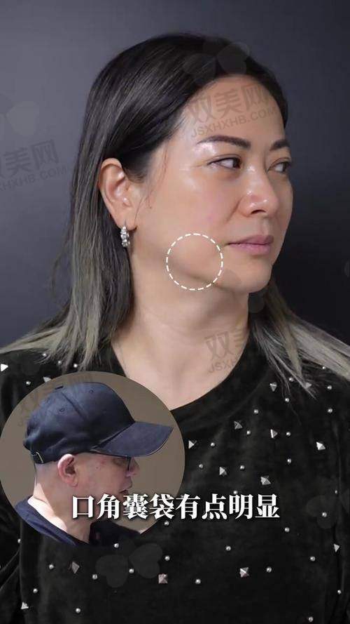 一、李健钢无痕筋膜提升，真的有那么神吗？
