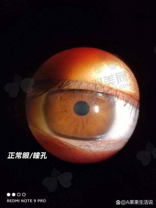 哪些人能做免费白内障手术？记住这几个关键就不怕被拒