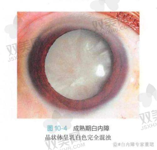 二次更换晶体的术前准备