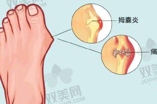 玻尿酸注射隆胸的价格因素