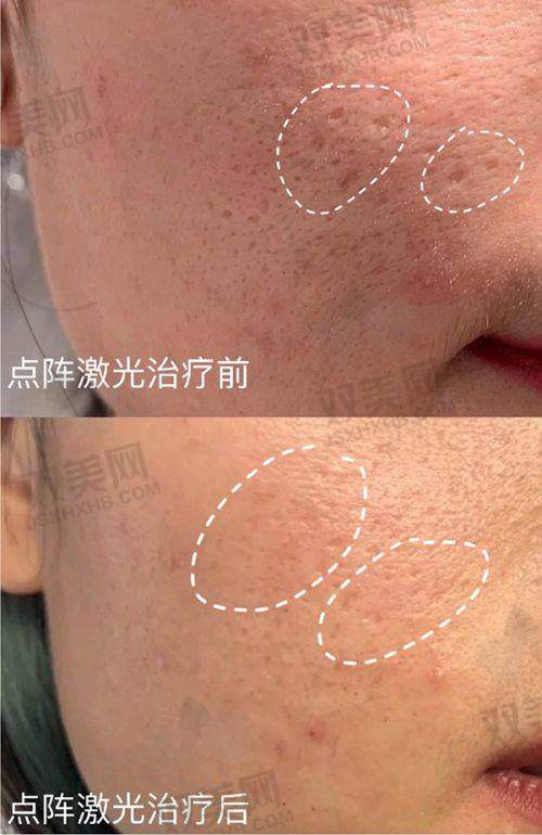 眼窝填充的风险
