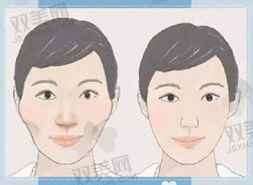 玻尿酸注射隆胸的注意事项