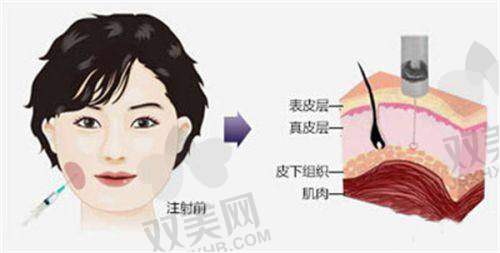 玻尿酸取出的费用是多少？