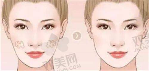 手术去除抬头纹