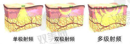 自体脂肪填充的潜在危害