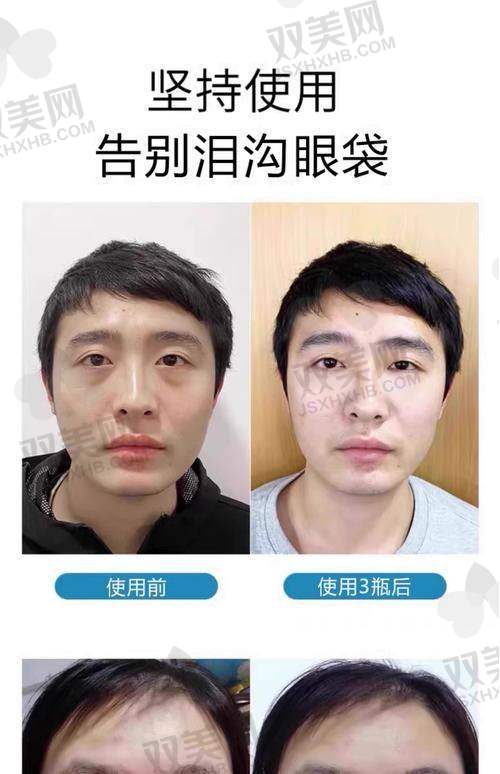 眼袋真是“心头刺”？我想是的！