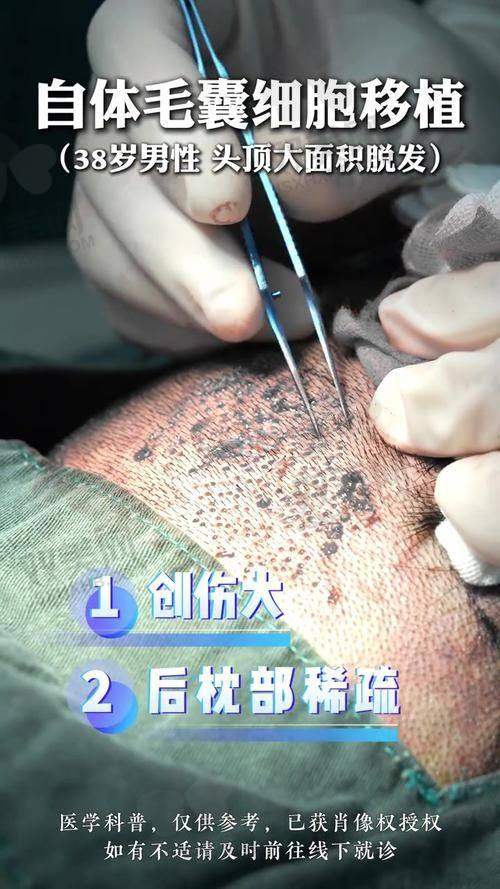 【毕节发博士植发医院擅长什么项目】