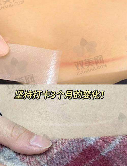 浅放srt - 100疤痕放疗后需要注意什么？