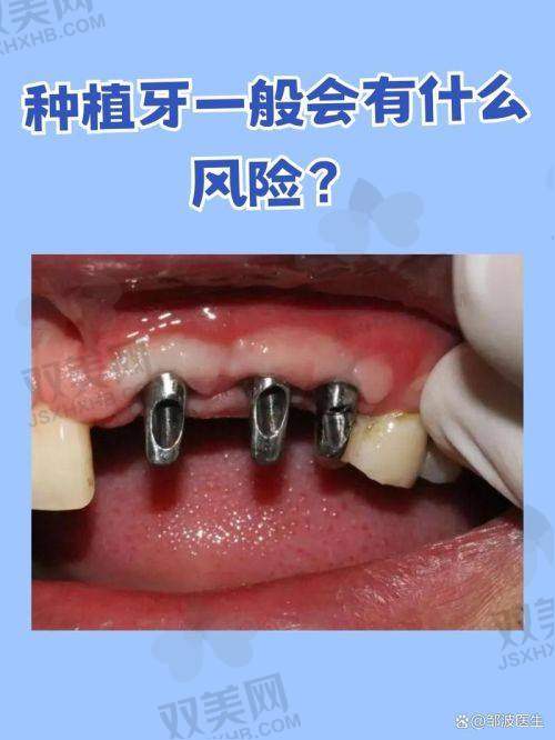 三、全隐形透明牙套｜长沙白领精英人群标配
