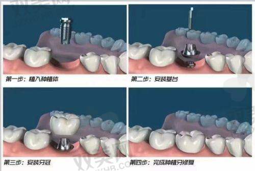 四、适应症区别：骨量不好选ITI，前牙精修选安卓健