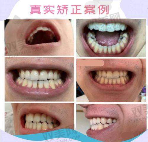 1. 可丽尔隐形矫正真的倒闭了吗？