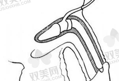 五、进阶项目大揭秘：增强型/延长型/自体组织协助型都多少钱？