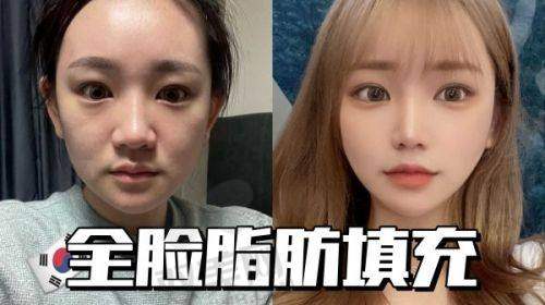 硬结消散的可能性