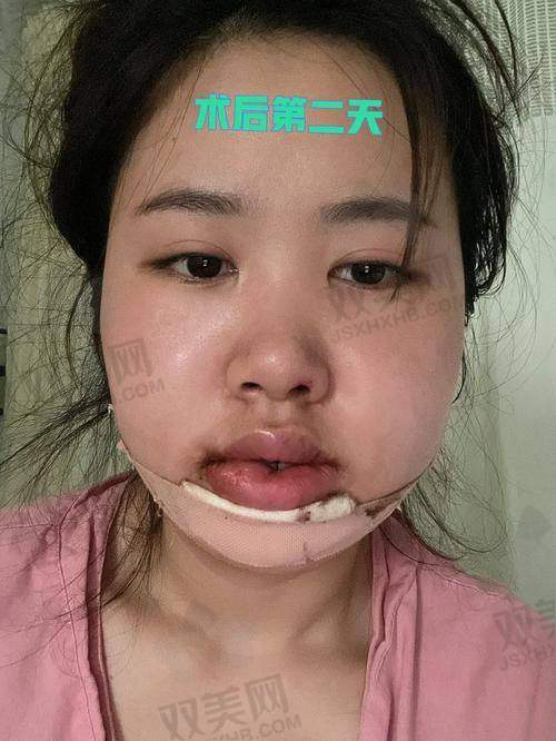 佛山禅城中 心医院整形外科中 心有哪些特色技术？3D导航+内窥镜=磨骨“显眼包”