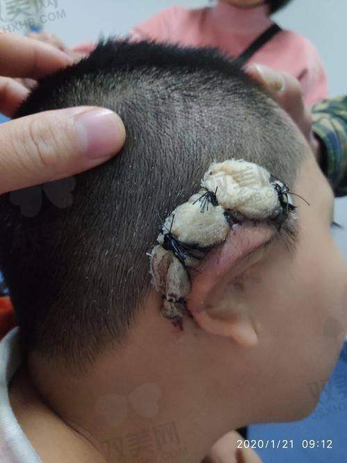 市面上耳整形选医院要看哪些关键点？
